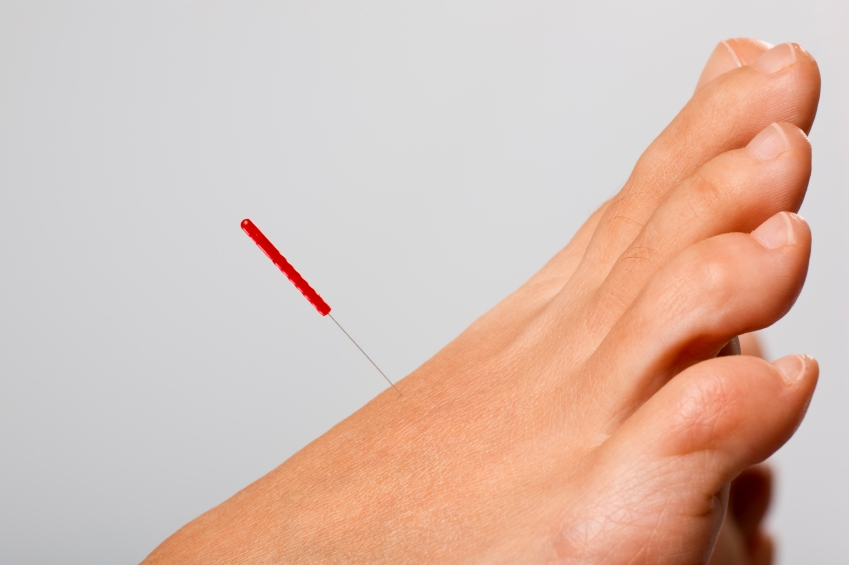 Western medical acupuncture