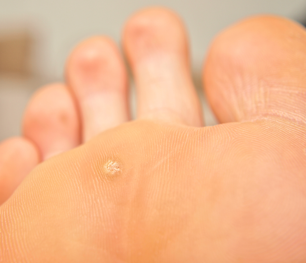 Verruca treatment