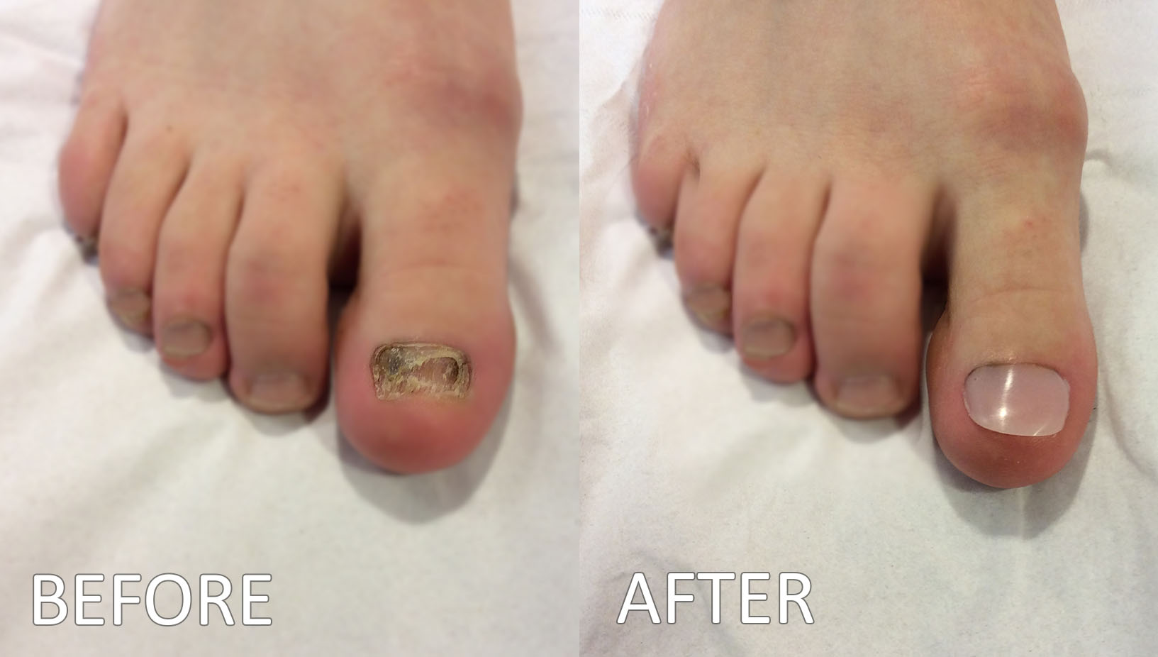 Toenail reconstruction