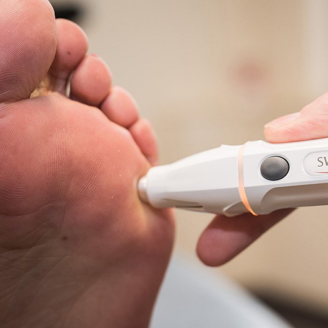 Swift verruca treatment