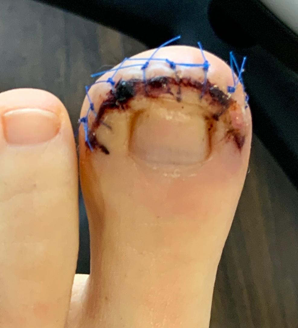 Dubois toe procedure